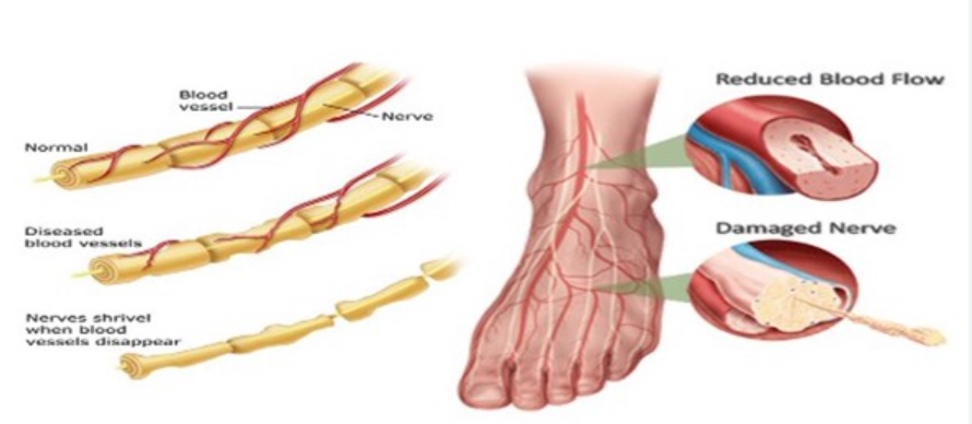 The Role Of Exercise In Managing Peripheral Neuropathy A Comprehensive